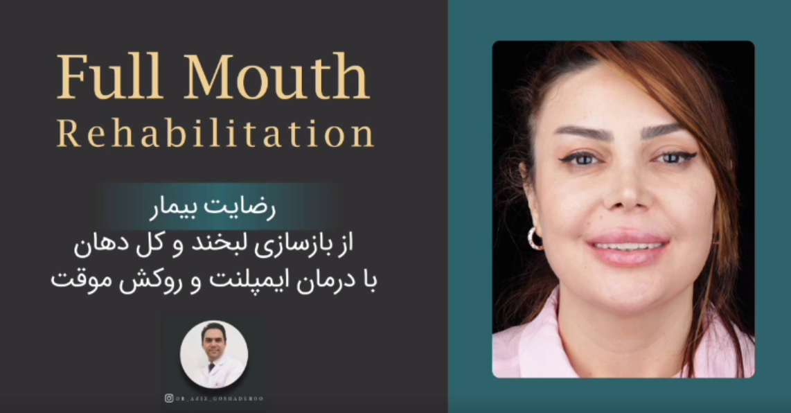 تجربه واقعی بیمار از بازسازی کامل دهان با ایمپلنت و تحویل روکش موقت در ۳ روز